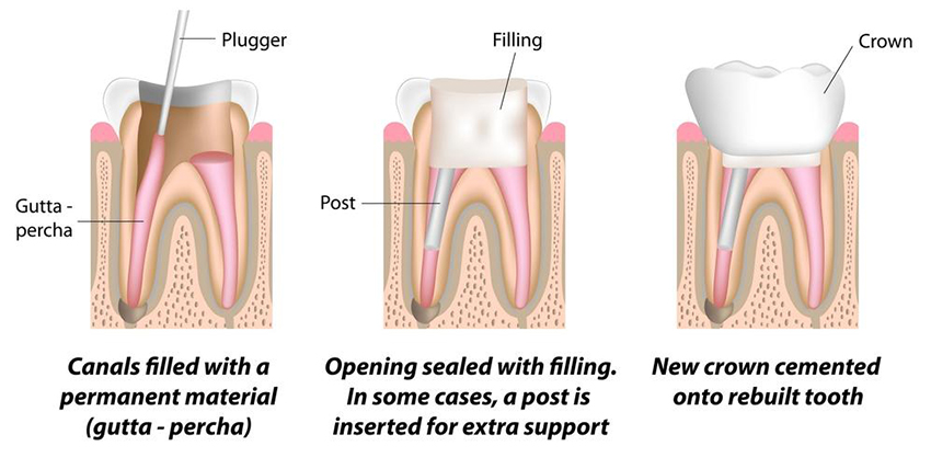 root-canal-crop